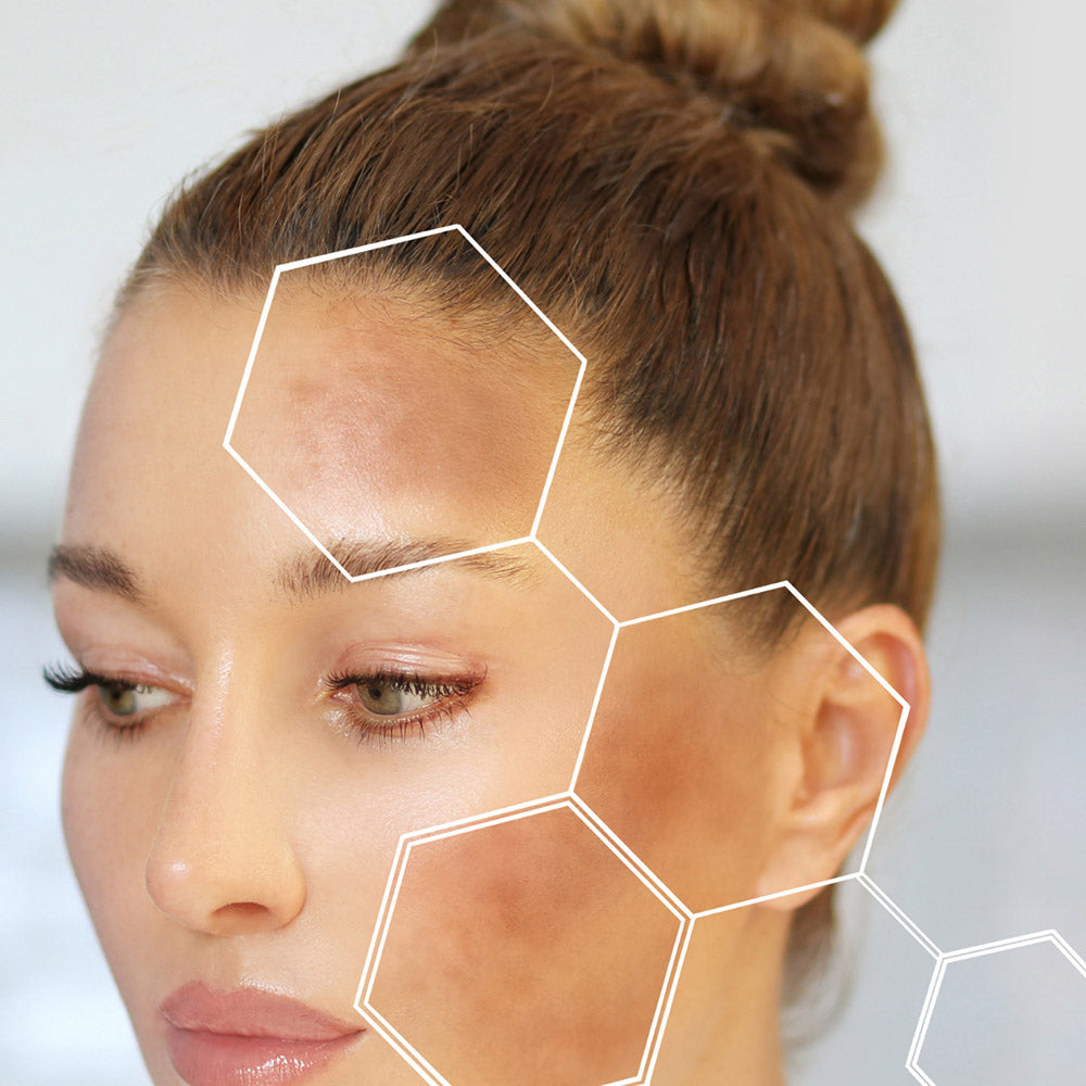 Everything You Need To Know About Hyperpigmentation